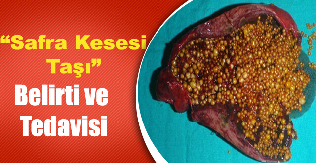 Safra Kesesi Taşları ve Tedavisi