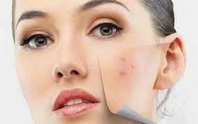 sivilceli ciltler için maske önerileri