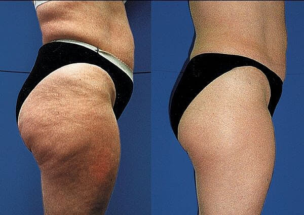 Selülite Sebep Olan Gıdalar Nelerdir 1