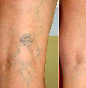 Gebelikte Varis ve Tedavi Yöntemleri