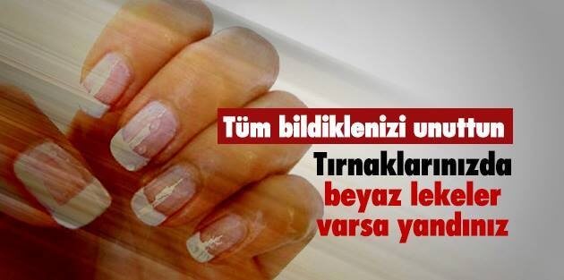 Tırnakta Beyaz Lekeler Nedenleri ve Tedavisi