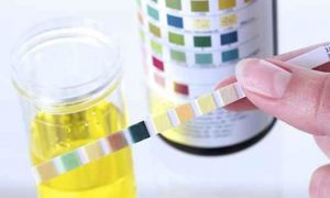 İdrar Tahlilinde Lökosit Çıkmasının Sebepleri ve Tedavisi