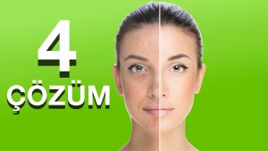 Gözenekleri Yok Etmek İçin Ne Yapmalı?