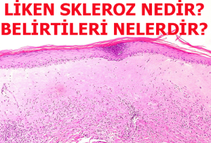 Liken Skleroz Nedir ve Tedavi Yöntemleri Nelerdir?