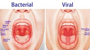 Boğaz ağrısına kesin çözüm
